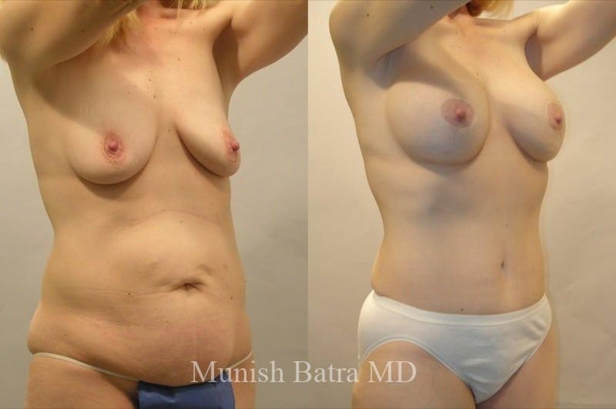 Mommy Makeover Before & After Gallery - Patient 708678 - Image 2
