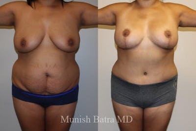 Mommy Makeover Before & After Gallery - Patient 255655 - Image 1