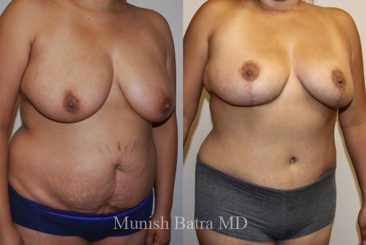 Mommy Makeover Before & After Gallery - Patient 255655 - Image 2