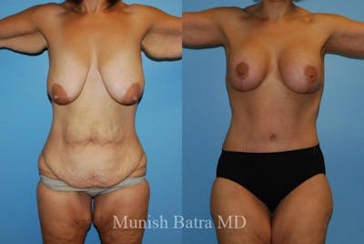 Breast Augmentation with Lift Mastopexy Before & After Gallery - Patient 135185 - Image 1