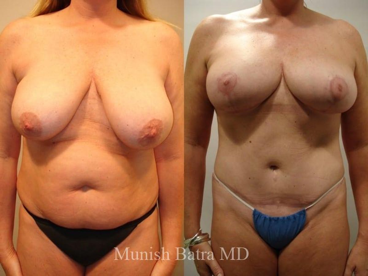 Mommy Makeover Before & After Gallery - Patient 928215 - Image 1