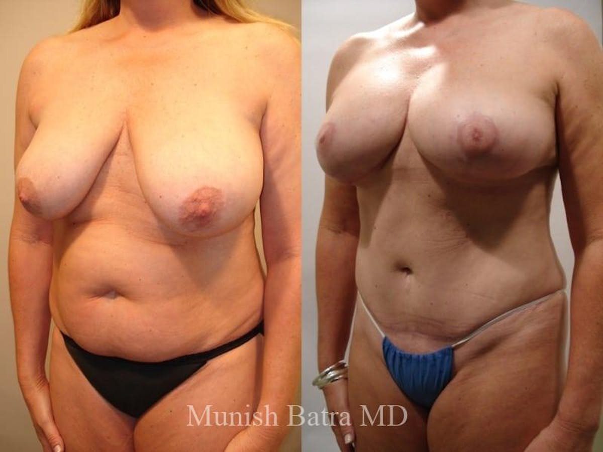 Mommy Makeover Before & After Gallery - Patient 928215 - Image 2