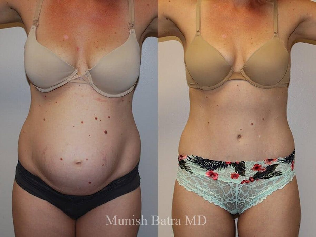 Tummy Tuck Before & After Gallery - Patient 160503 - Image 1