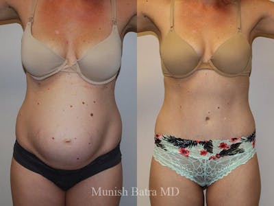 Tummy Tuck Before & After Gallery - Patient 160503 - Image 1
