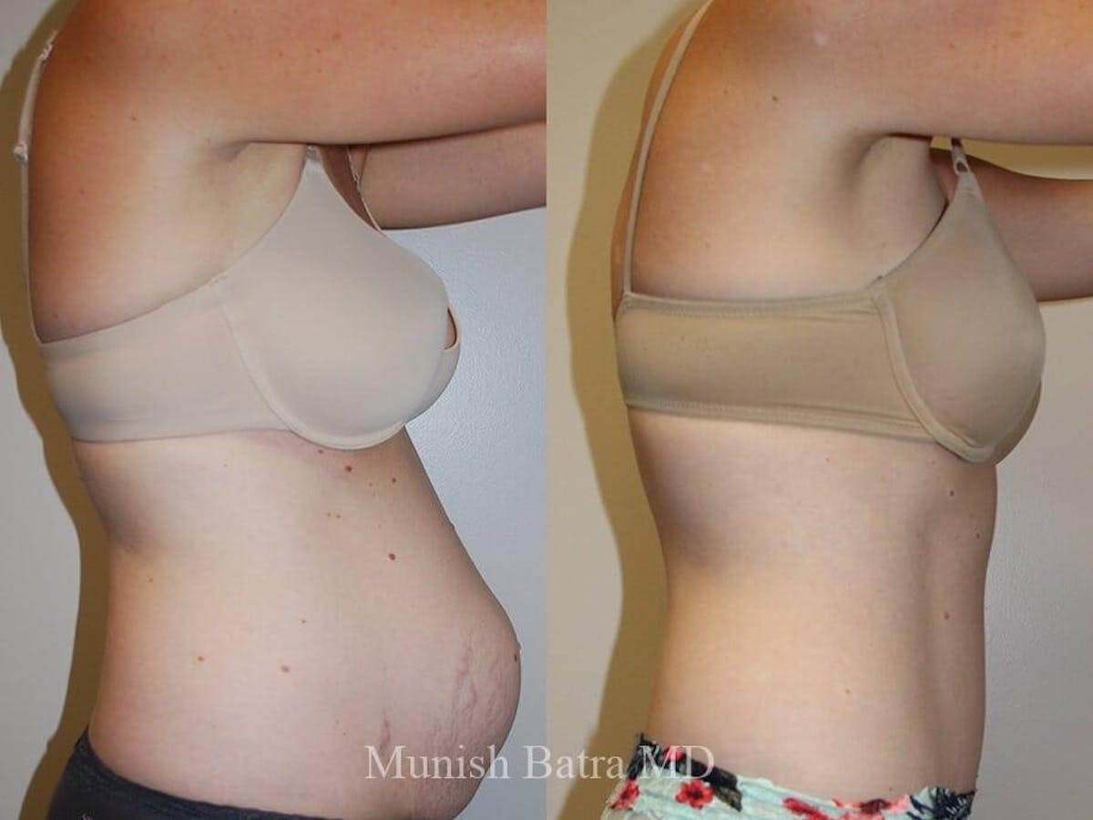 Tummy Tuck Before & After Gallery - Patient 160503 - Image 2