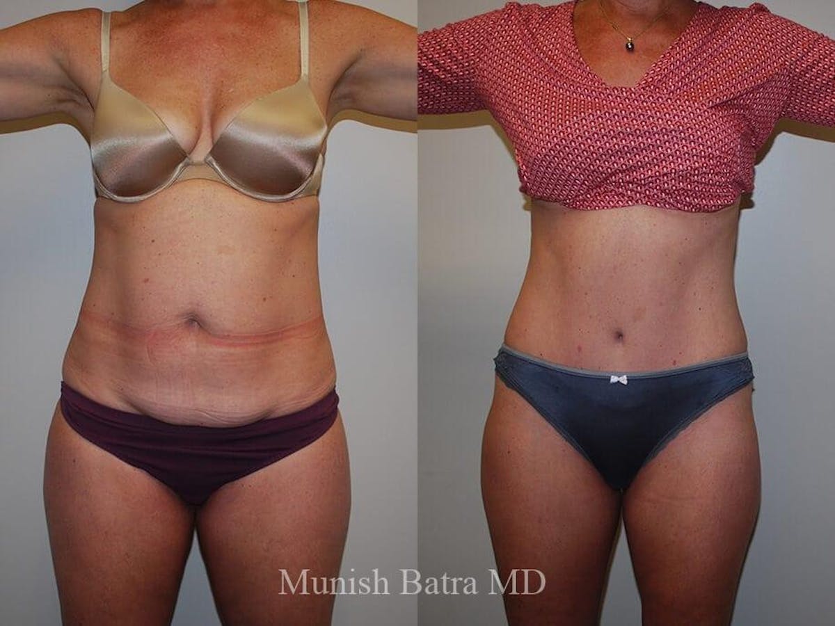 Tummy Tuck Before & After Gallery - Patient 412575 - Image 1