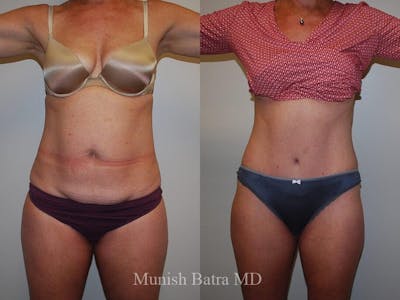 Tummy Tuck Before & After Gallery - Patient 412575 - Image 1
