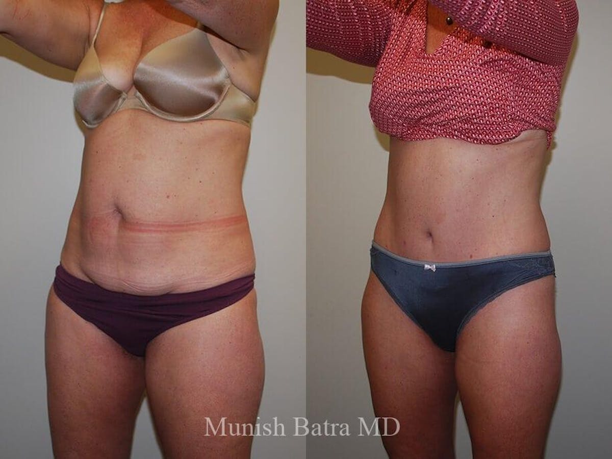 Tummy Tuck Before & After Gallery - Patient 412575 - Image 2