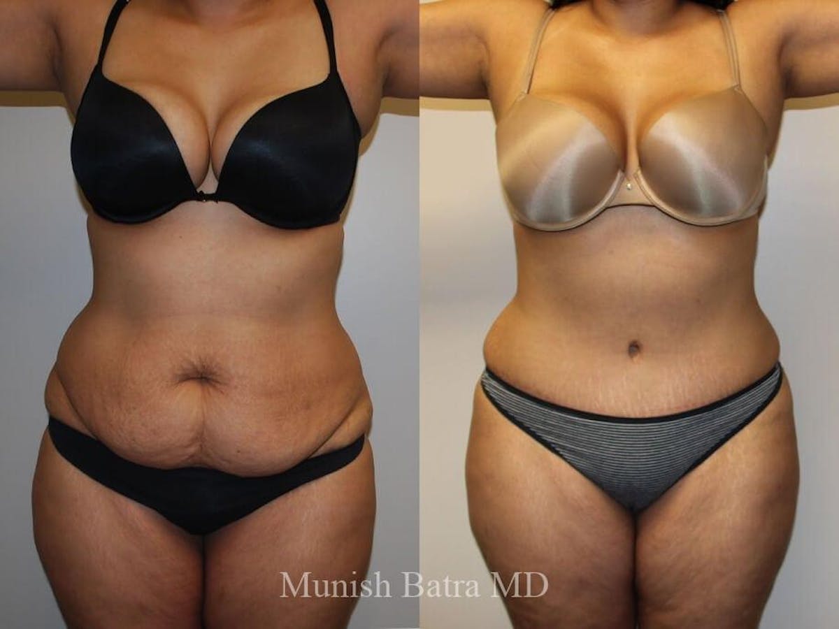 Tummy Tuck Before & After Gallery - Patient 249957 - Image 1