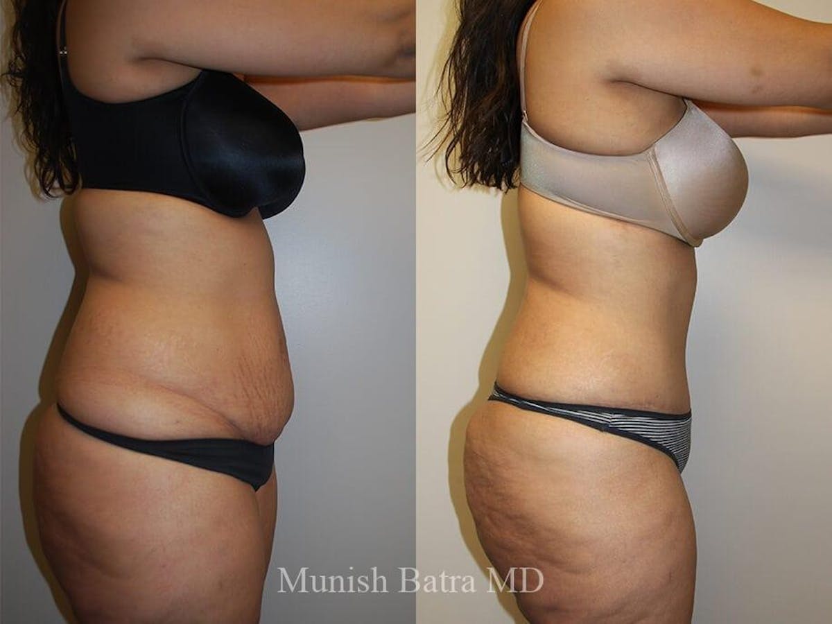 Tummy Tuck Before & After Gallery - Patient 249957 - Image 2