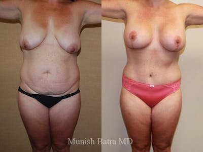 Tummy Tuck Before & After Gallery - Patient 157468 - Image 1