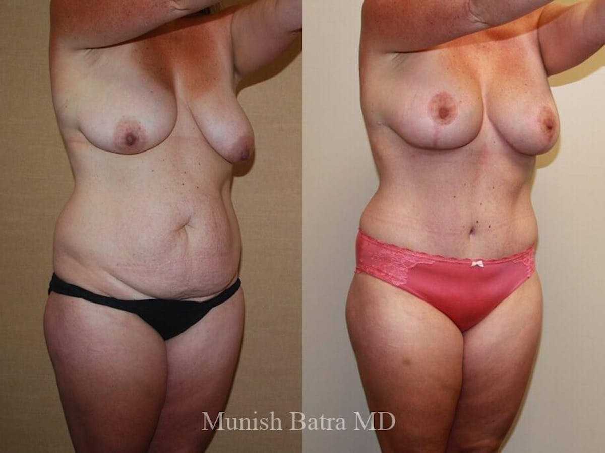 Tummy Tuck Before & After Gallery - Patient 157468 - Image 2