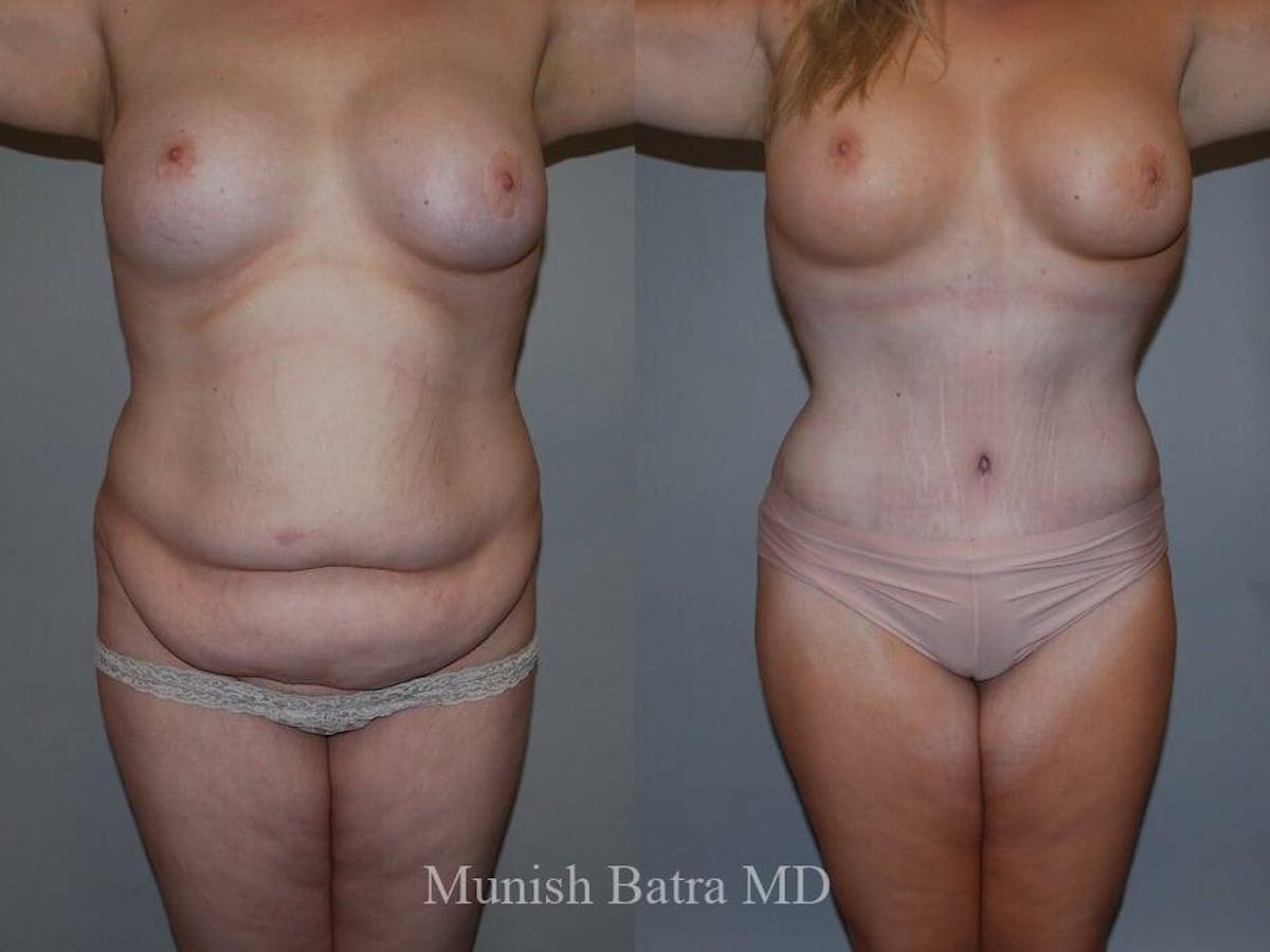 Tummy Tuck Before & After Gallery - Patient 186213 - Image 1