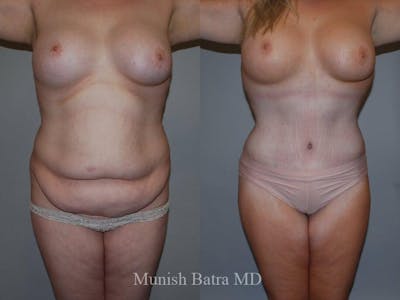 Tummy Tuck Before & After Gallery - Patient 186213 - Image 1