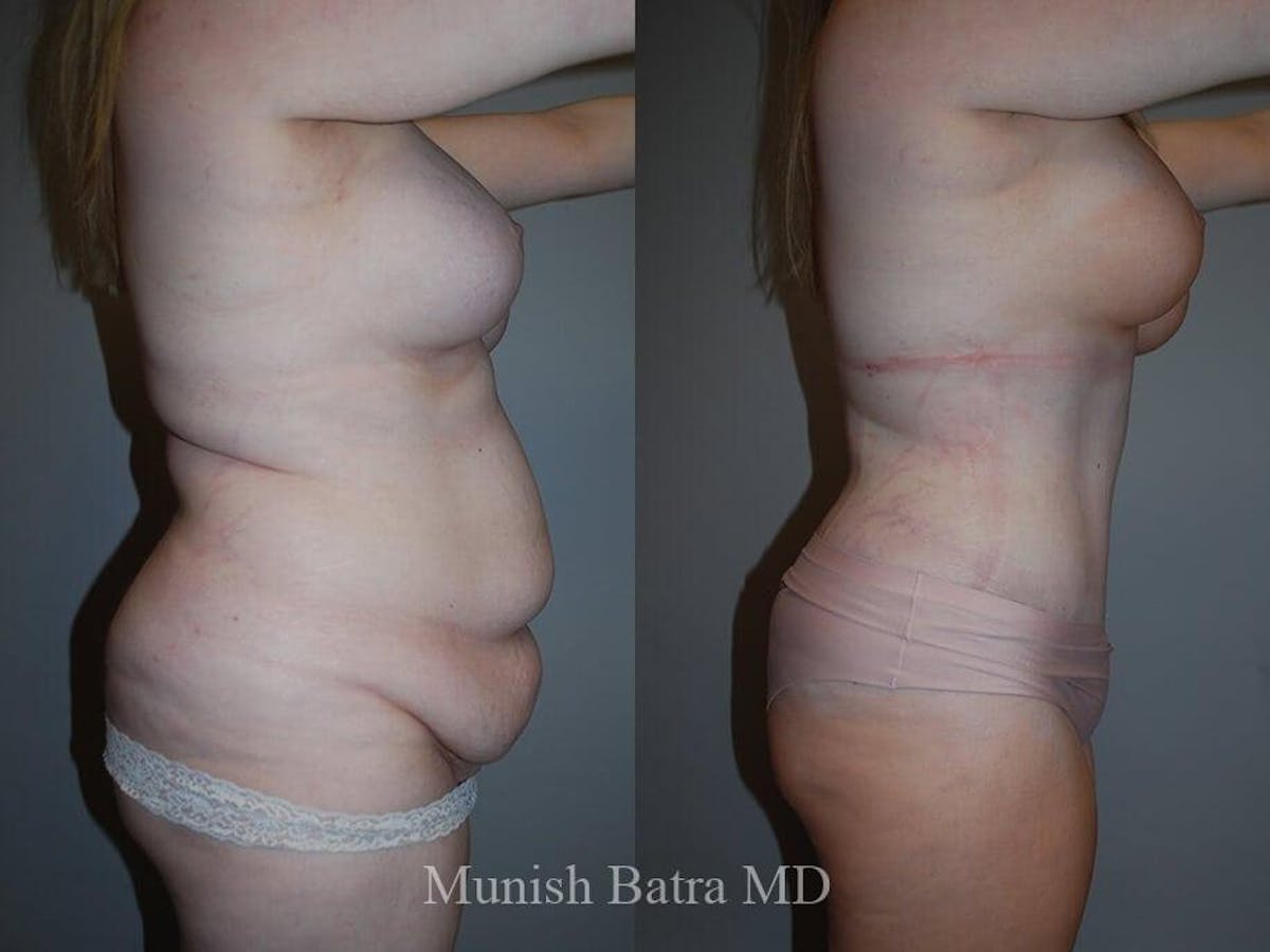 Tummy Tuck Before & After Gallery - Patient 186213 - Image 2