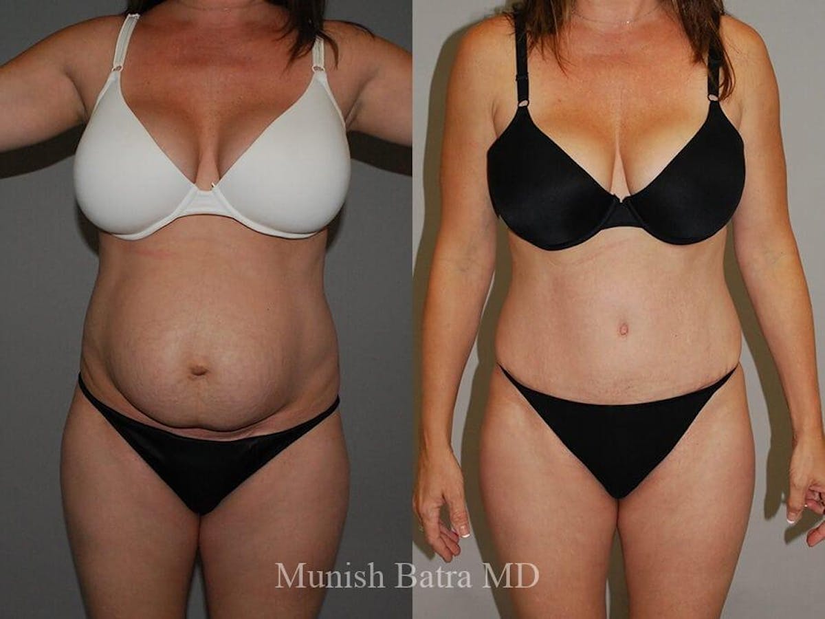 Tummy Tuck Before & After Gallery - Patient 319227 - Image 1