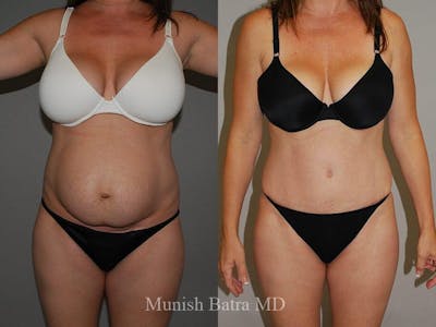 Tummy Tuck Before & After Gallery - Patient 319227 - Image 1