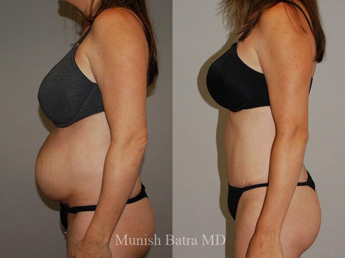 Tummy Tuck Before & After Gallery - Patient 319227 - Image 2