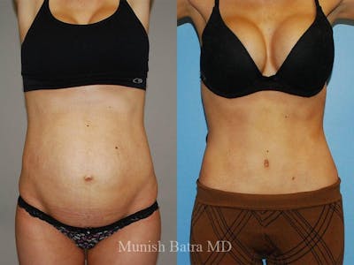 Tummy Tuck Before & After Gallery - Patient 275041 - Image 1