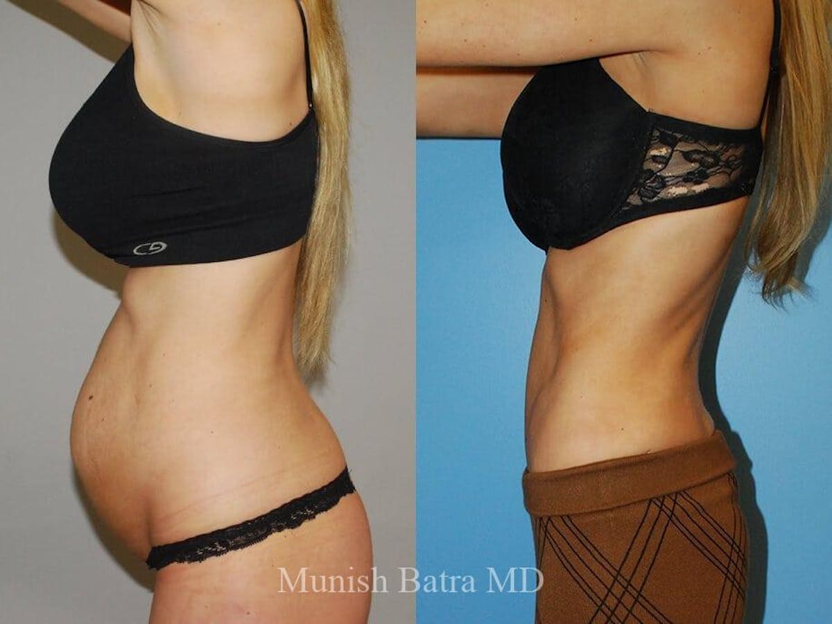 Tummy Tuck Before & After Gallery - Patient 275041 - Image 2