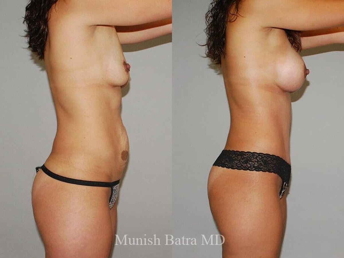 Tummy Tuck Before & After Gallery - Patient 167649 - Image 2