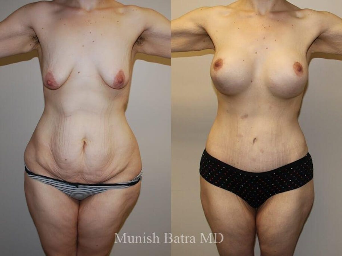 Tummy Tuck Before & After Gallery - Patient 130172 - Image 1