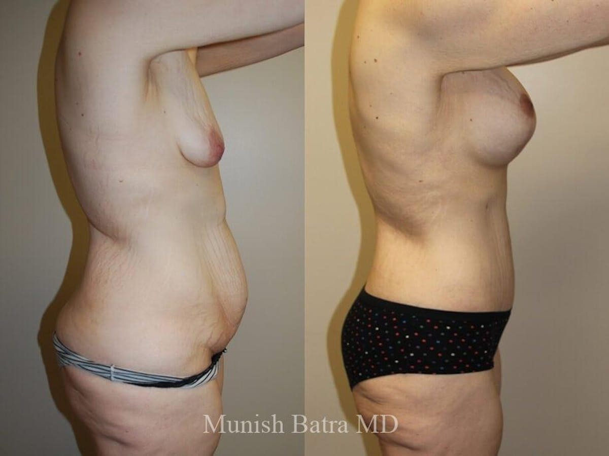 Tummy Tuck Before & After Gallery - Patient 130172 - Image 2