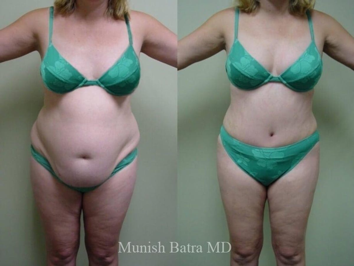 Tummy Tuck Before & After Gallery - Patient 259082 - Image 1