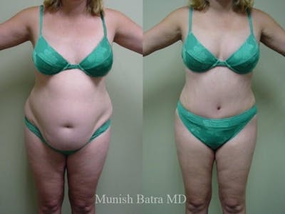 Tummy Tuck Before & After Gallery - Patient 259082 - Image 1