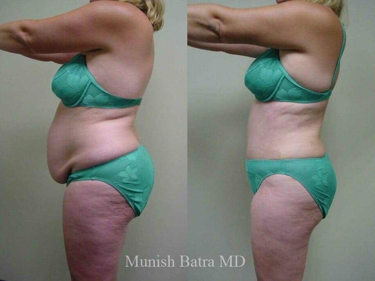 Tummy Tuck Before & After Gallery - Patient 259082 - Image 2