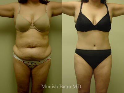 Tummy Tuck Before & After Gallery - Patient 952205 - Image 1