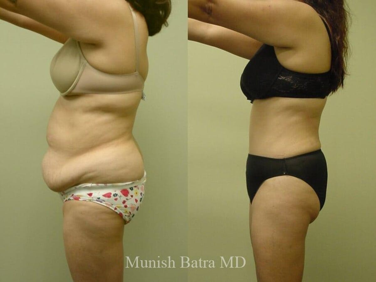Tummy Tuck Before & After Gallery - Patient 952205 - Image 2