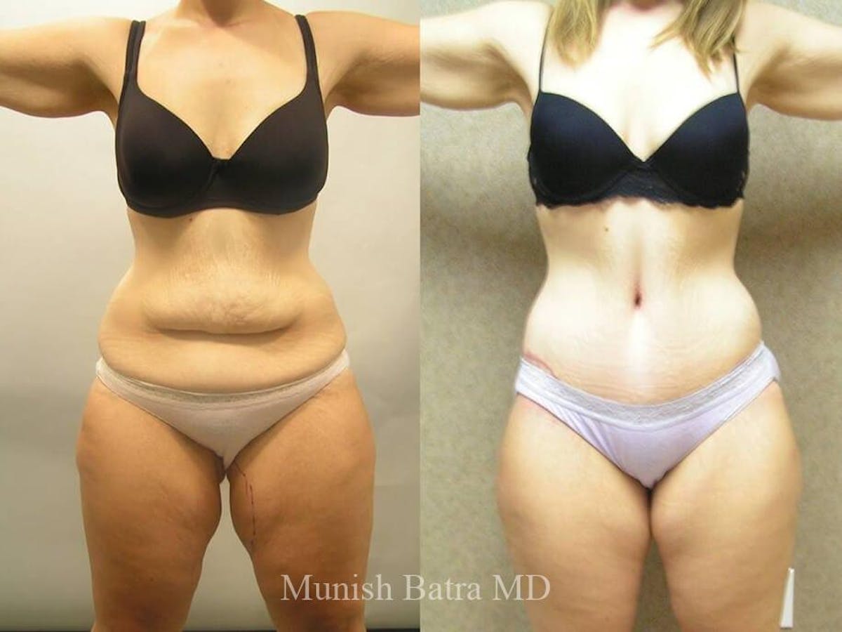 Tummy Tuck Before & After Gallery - Patient 360522 - Image 1