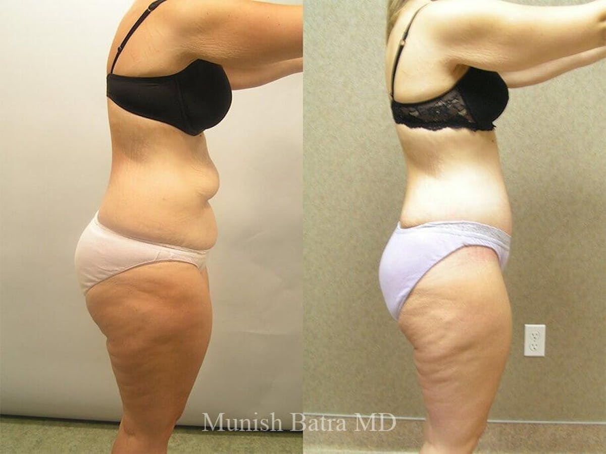 Tummy Tuck Before & After Gallery - Patient 360522 - Image 2