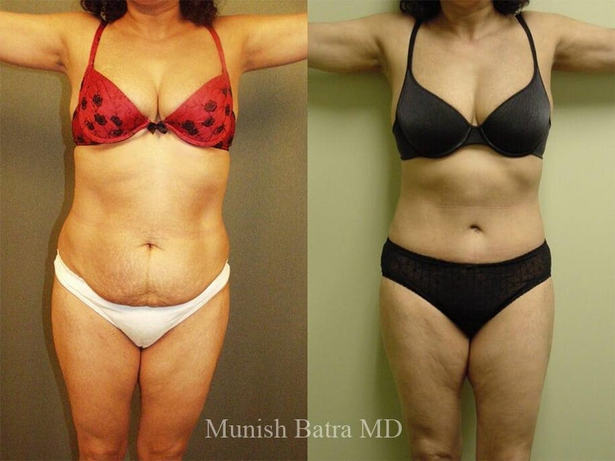 Tummy Tuck Before & After Gallery - Patient 236179 - Image 1