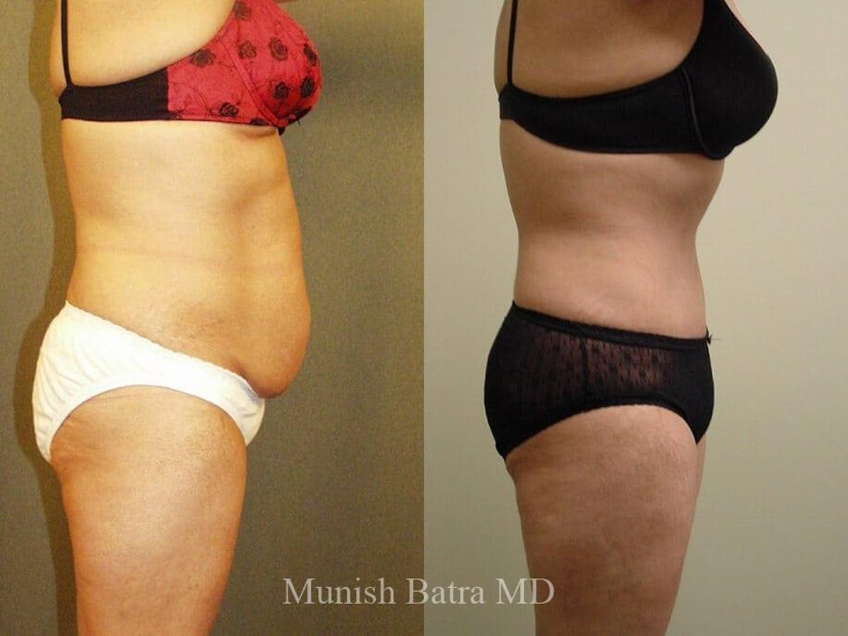 Tummy Tuck Before & After Gallery - Patient 236179 - Image 2