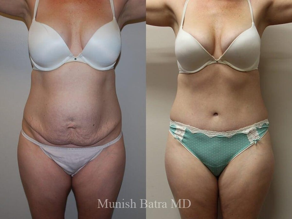 Tummy Tuck Before & After Gallery - Patient 151324 - Image 1