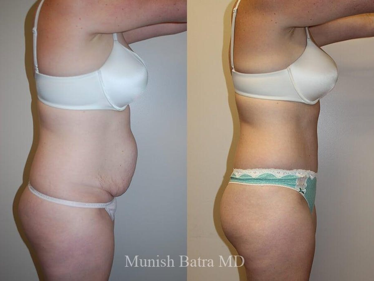 Tummy Tuck Before & After Gallery - Patient 151324 - Image 2
