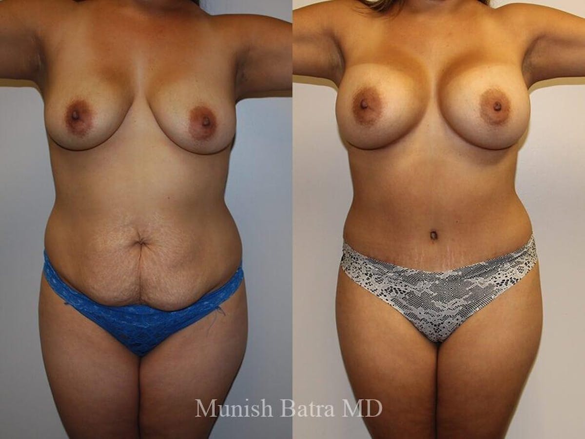Tummy Tuck Before & After Gallery - Patient 239367 - Image 1