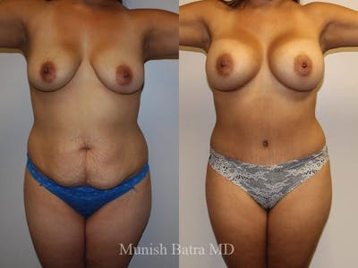 Tummy Tuck Before & After Gallery - Patient 239367 - Image 1