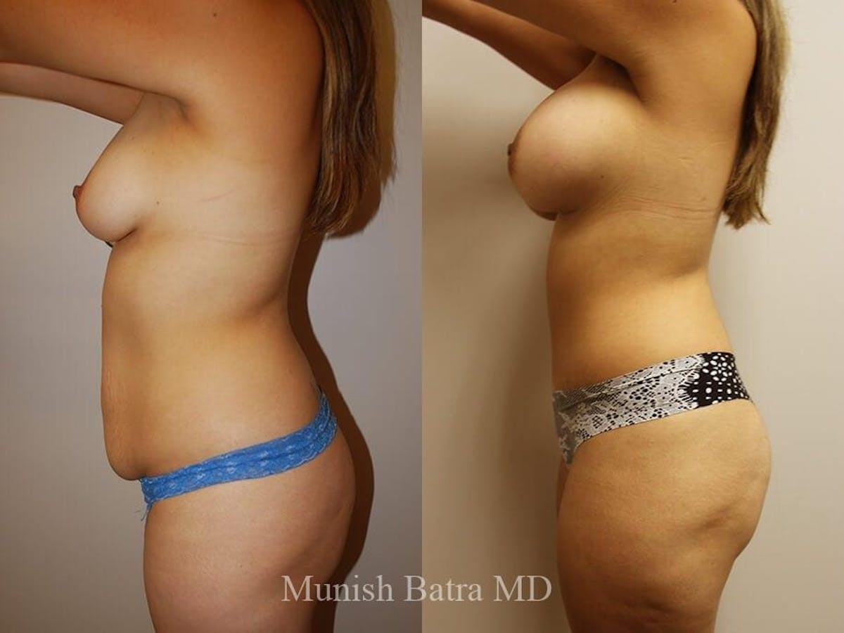 Tummy Tuck Before & After Gallery - Patient 239367 - Image 2