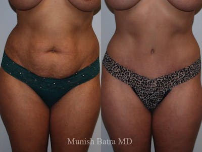 Tummy Tuck Before & After Gallery - Patient 691893 - Image 1