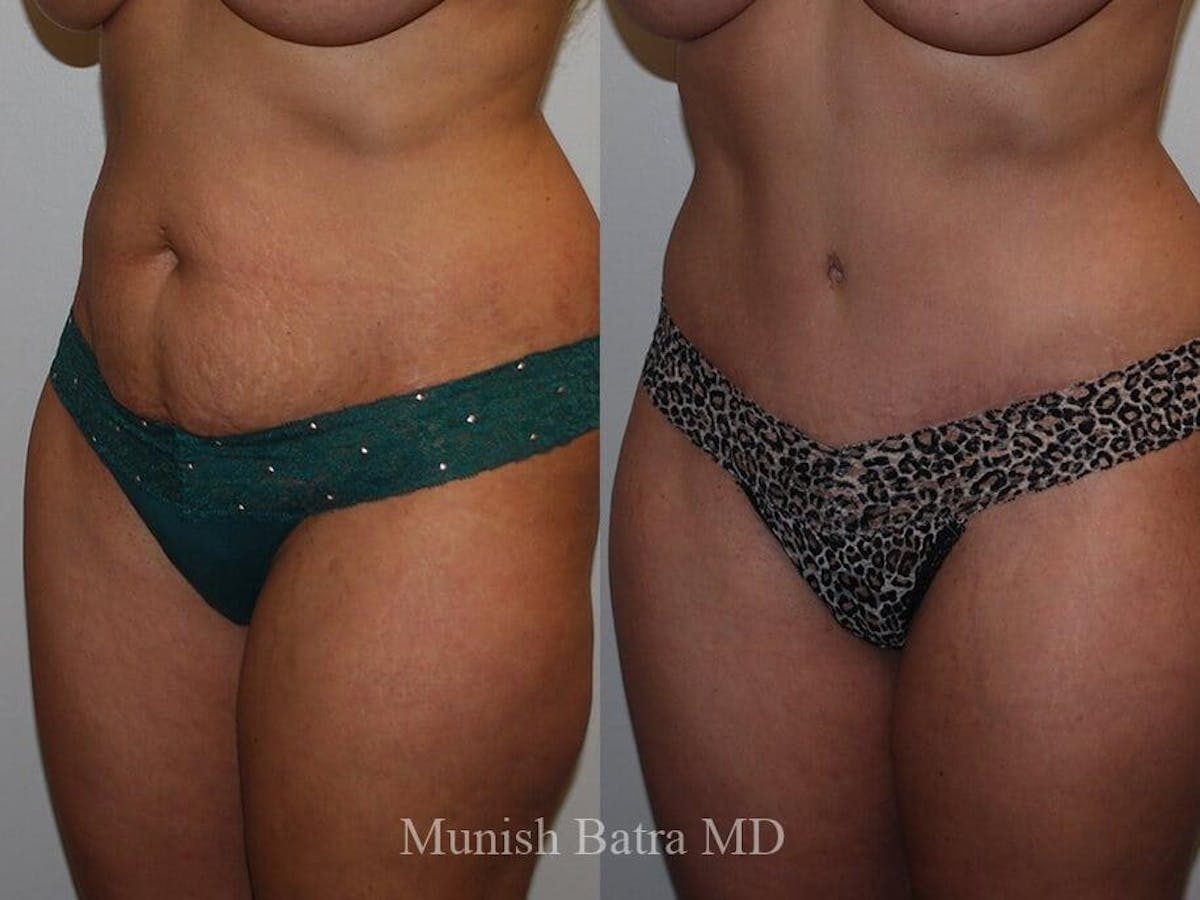 Tummy Tuck Before & After Gallery - Patient 691893 - Image 2