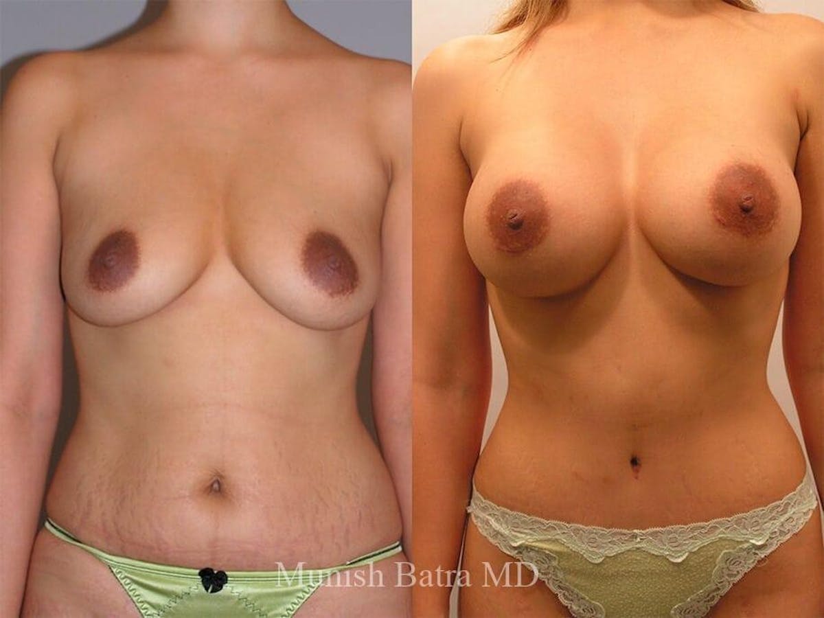 Tummy Tuck Before & After Gallery - Patient 157419 - Image 1