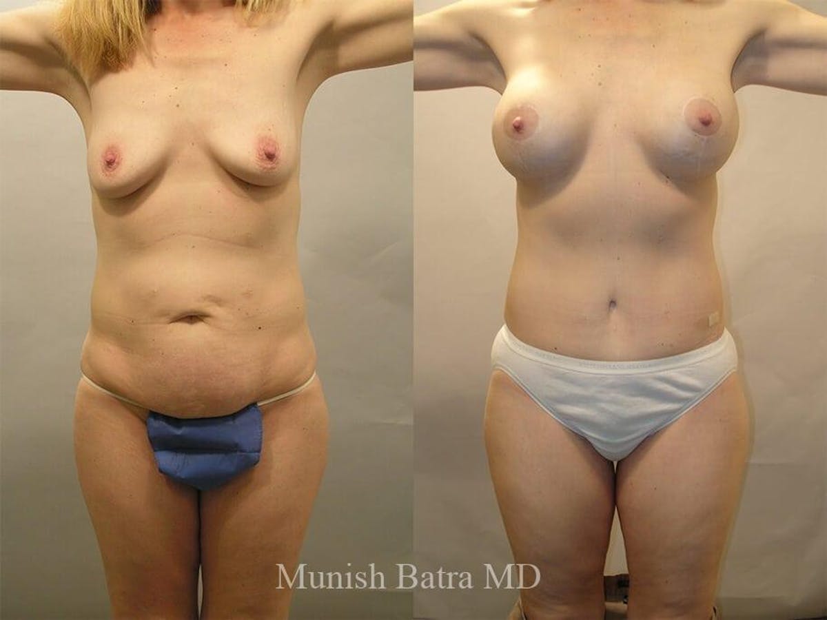 Tummy Tuck Before & After Gallery - Patient 210362 - Image 1