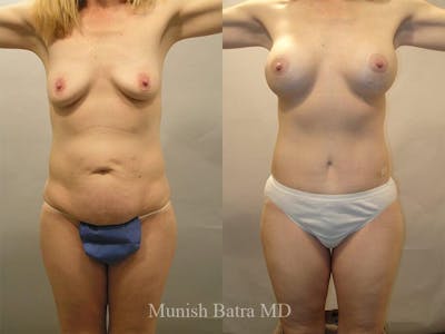 Tummy Tuck Before & After Gallery - Patient 210362 - Image 1