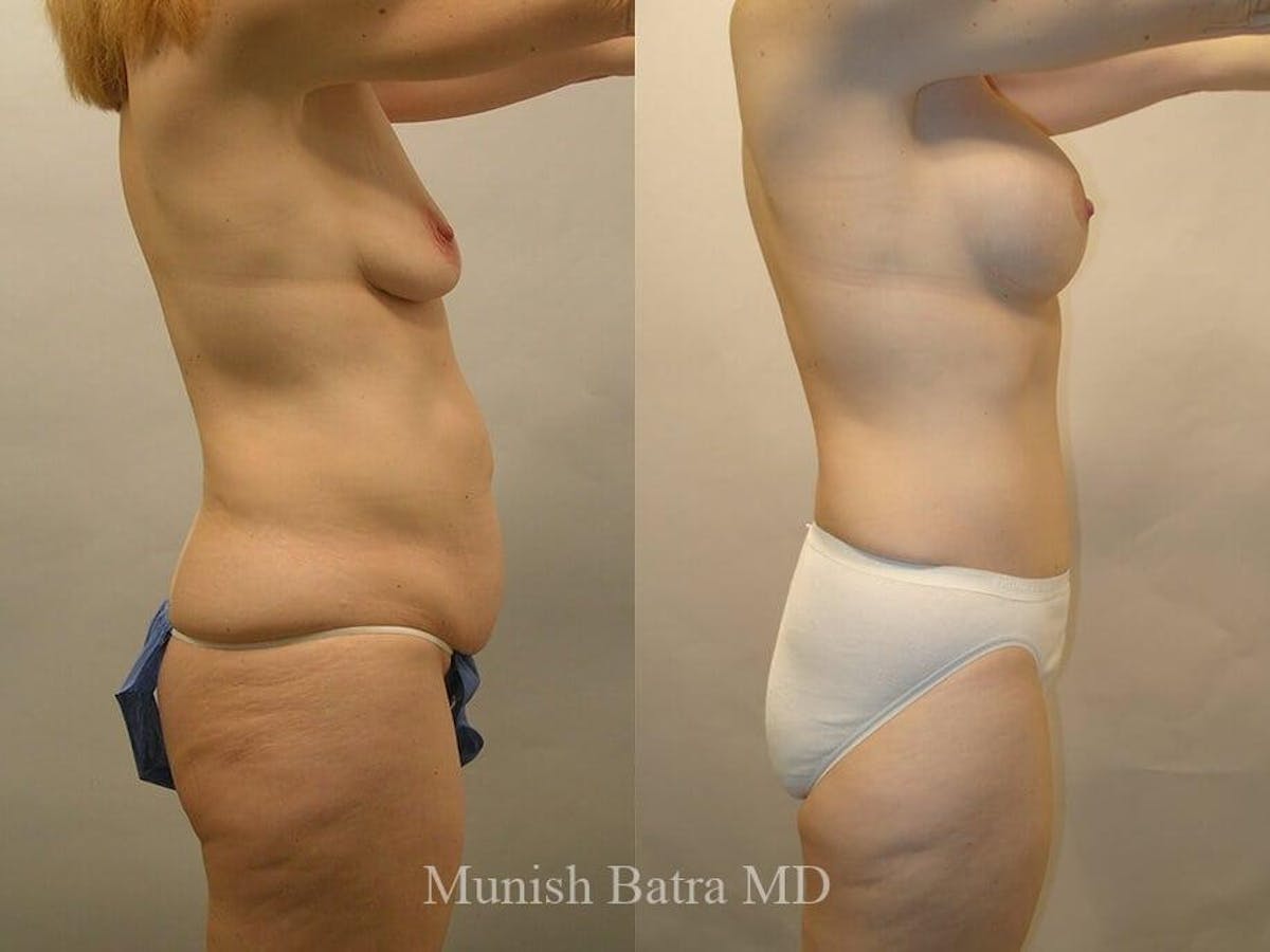 Tummy Tuck Before & After Gallery - Patient 210362 - Image 2