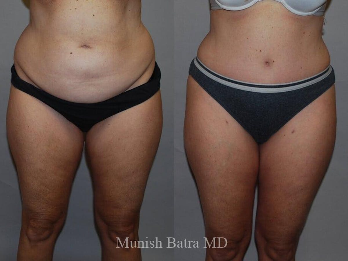 Tummy Tuck Before & After Gallery - Patient 325599 - Image 1