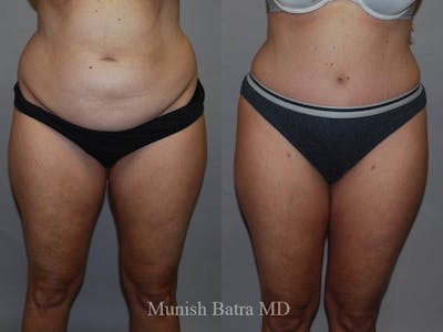 Tummy Tuck Before & After Gallery - Patient 325599 - Image 1