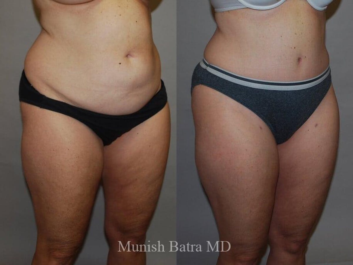 Tummy Tuck Before & After Gallery - Patient 325599 - Image 2